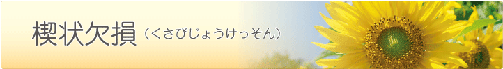 楔状欠損（くさびじょうけっそん）